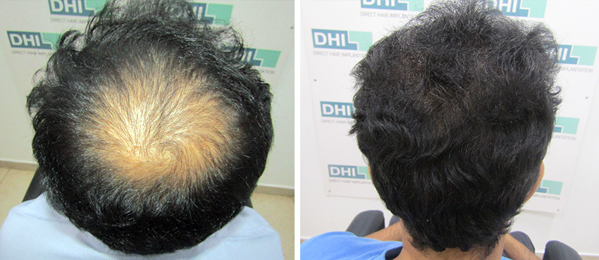 DHI before & after hair transplant results